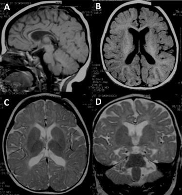 Novel Compound Heterozygous Mutations in the TRAPPC9 Gene in Two Siblings With Autism and Intellectual Disability